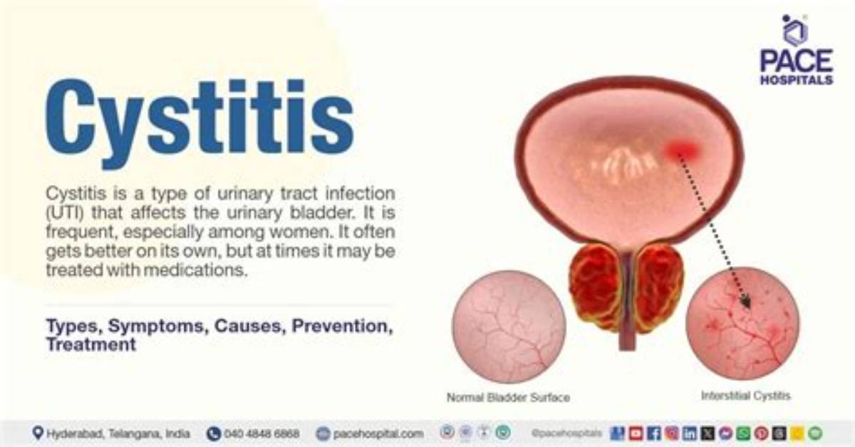 Non Bacterial Cystitis