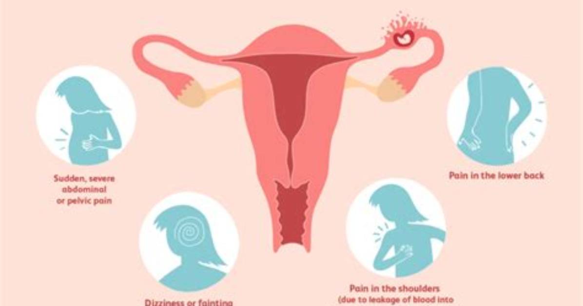 On Ruptured Ectopic Pregnancy?