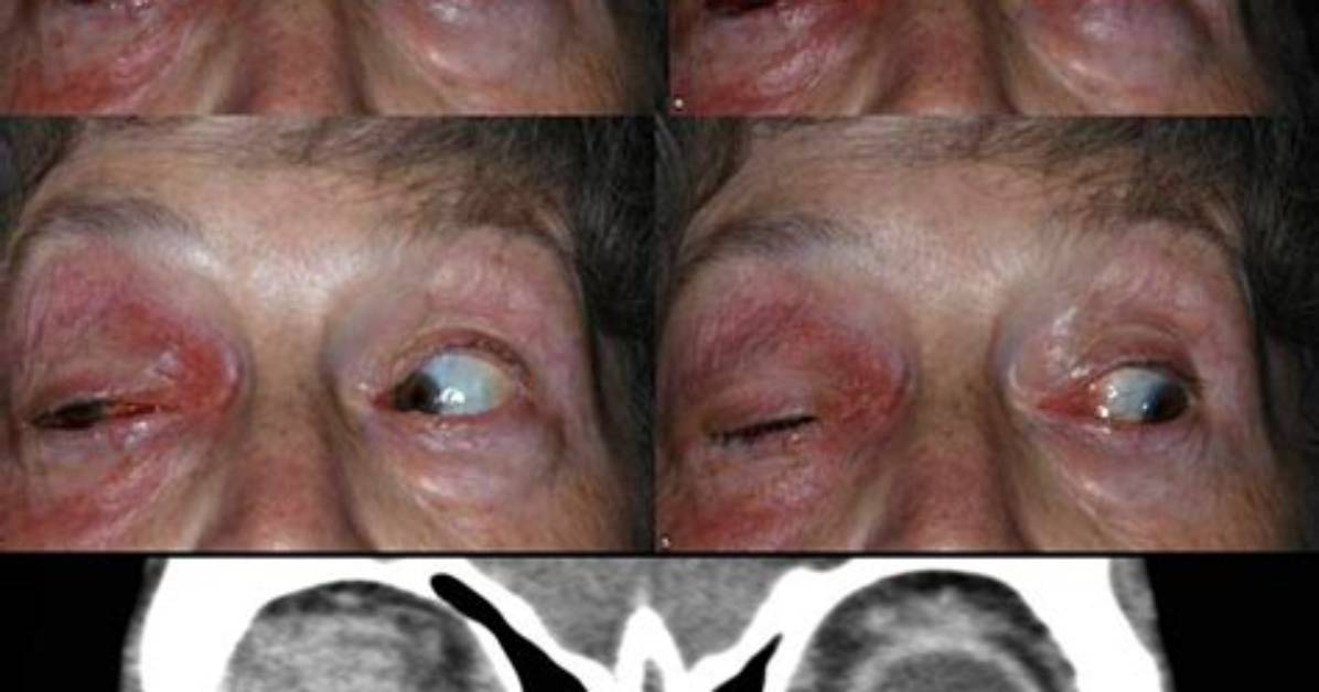 Orbital Pseudotumor