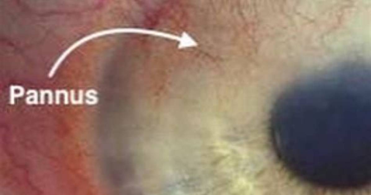 Pannus Eye Human