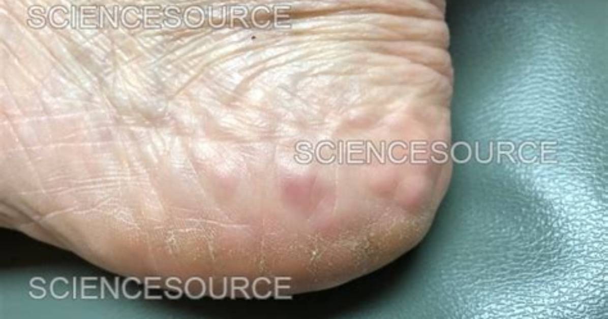 Piezogenic Papules