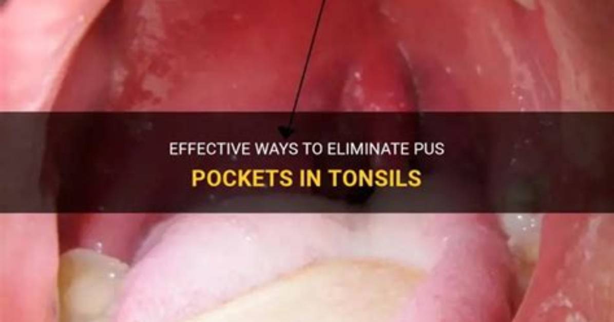 Popping Tonsil Pus Pockets