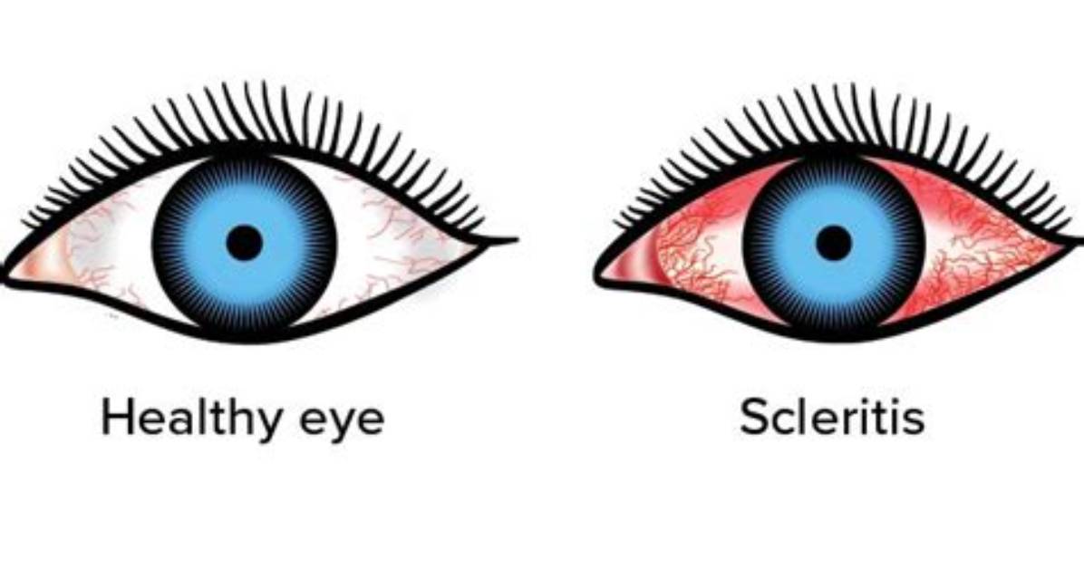 Scleritis - All About Vision