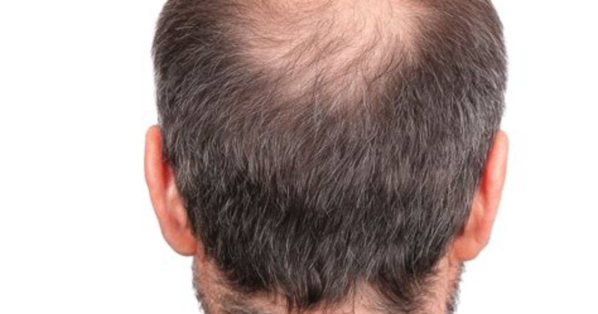 Shoppers Claim Bald Spots Are Gone Because of Kitsch’s Hair Bars