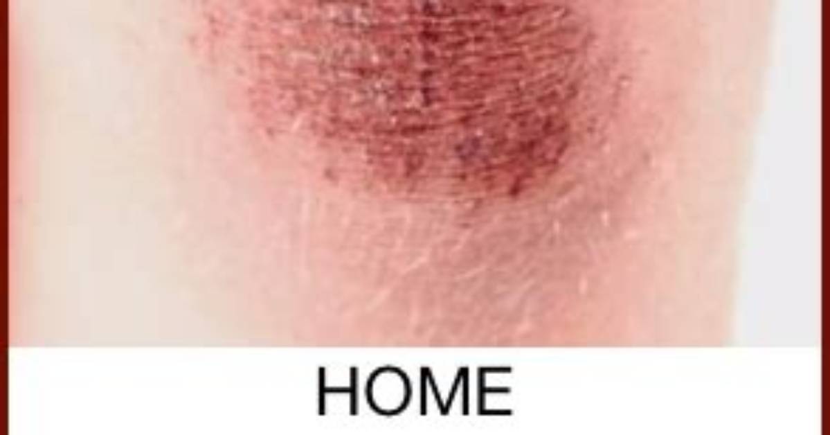 Should a Scraped Knee Be Covered?