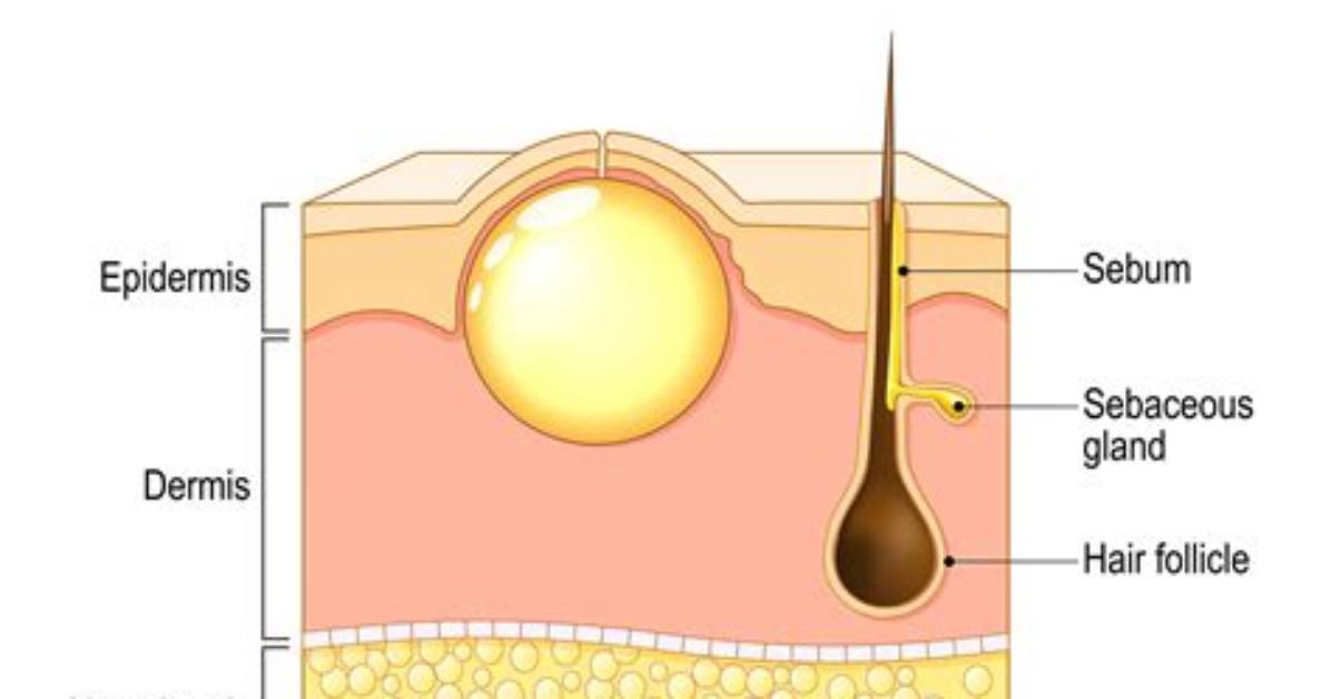 Should a Sebaceous Cyst Be Lanced?