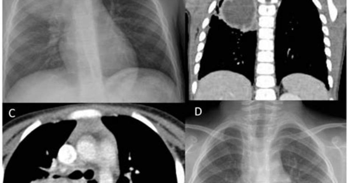 Should Bronchogenic Cysts Be Removed?