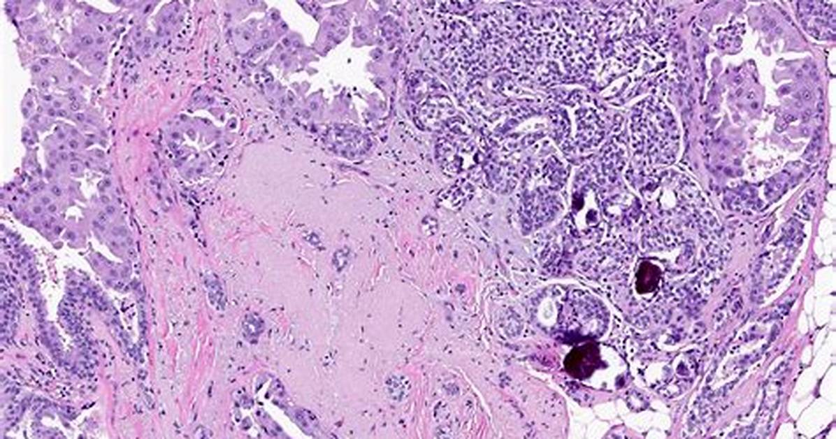 Should Complex Sclerosing Lesion Be Removed?