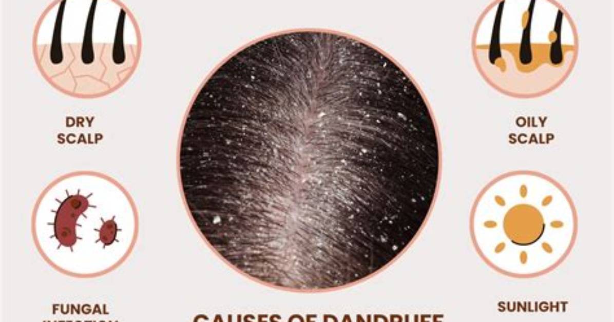 Should Dandruff Be Scratched?