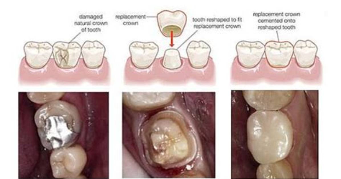 Should Dentist Replace Crown Free?