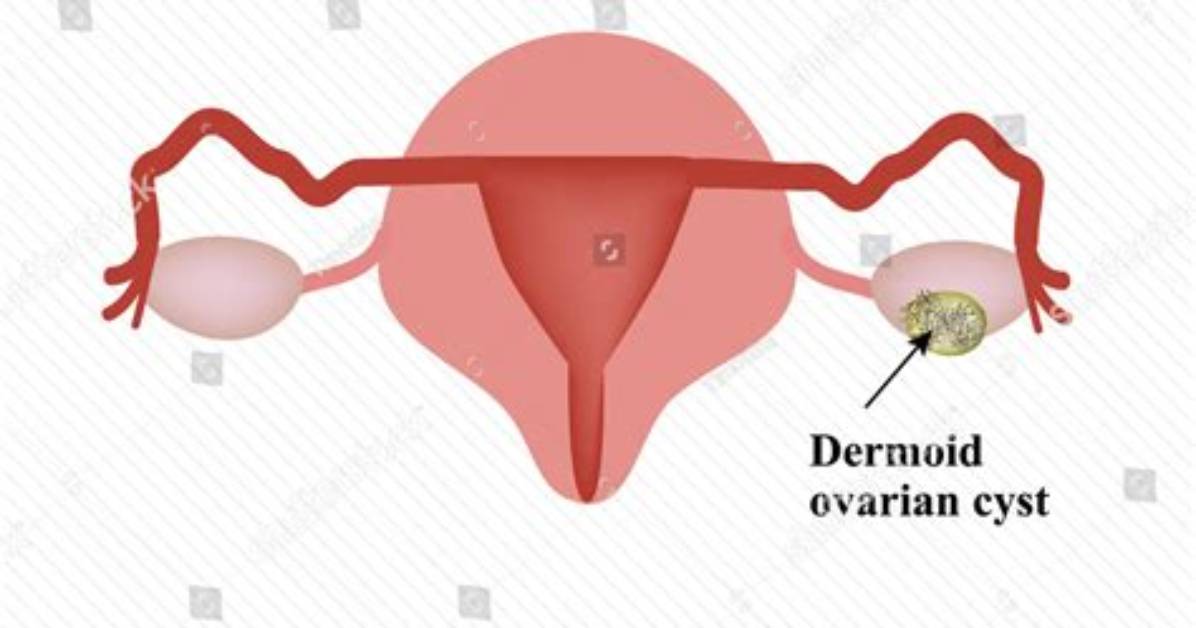 Should Dermoid Cysts Be Removed?