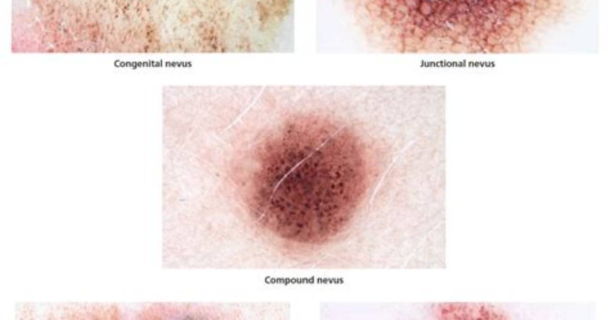 Should Dysplastic Nevi Be Removed?