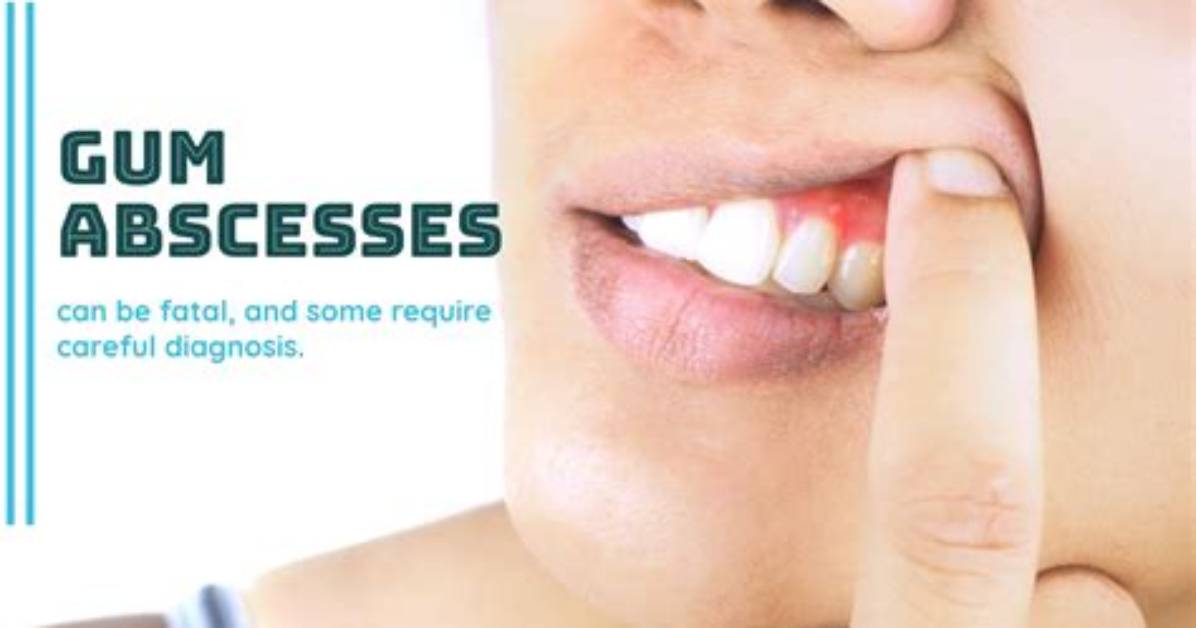 Should I Squeeze Gum Abscess?