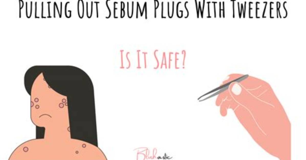 Should I Squeeze Sebum Plugs?