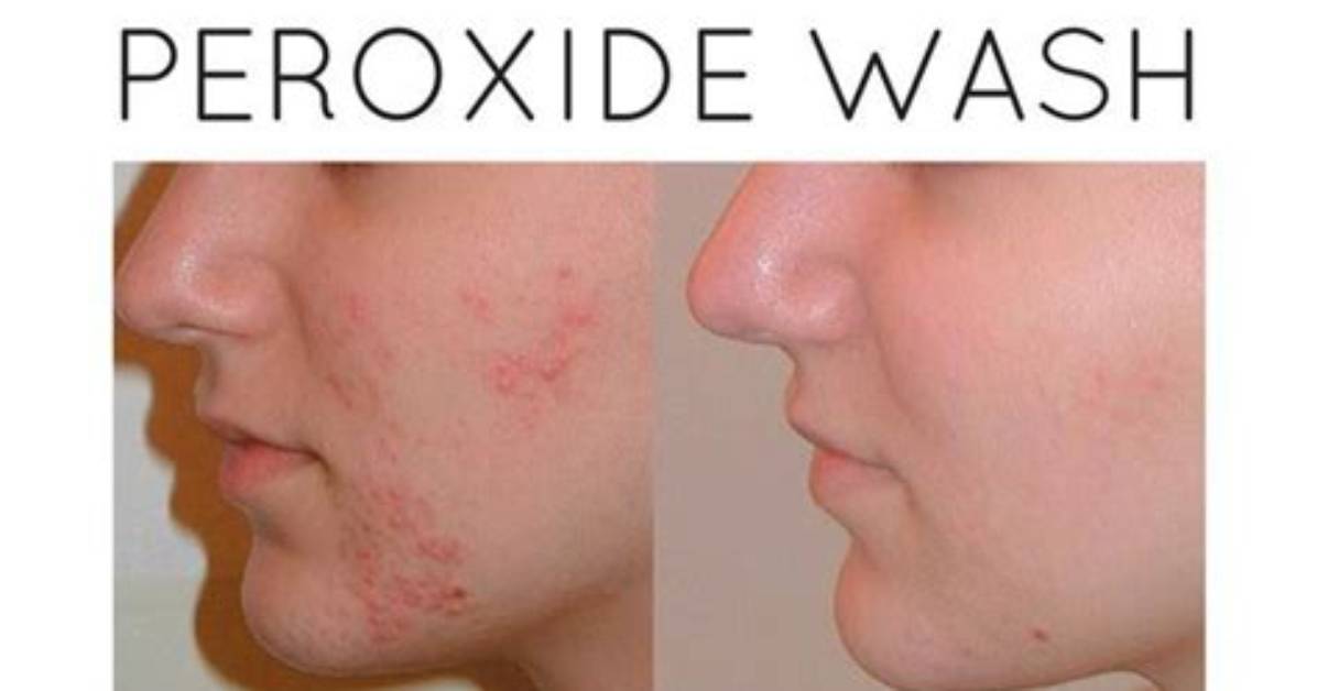 Should I Stop Using Benzoyl Peroxide?