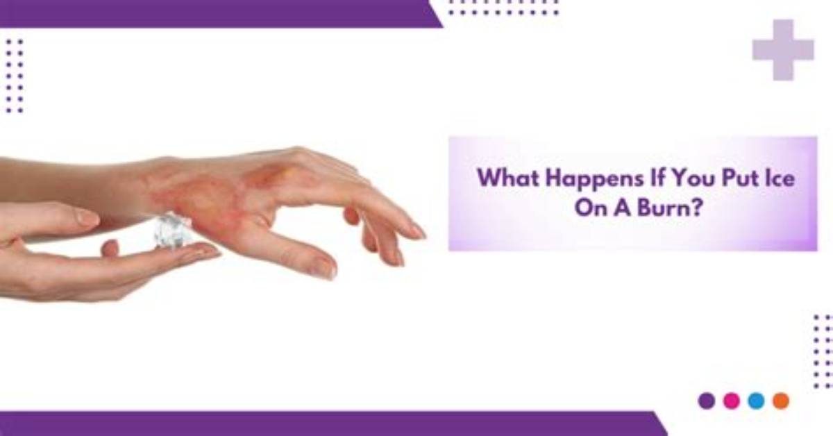 Should Ice Be Put on a Burn?
