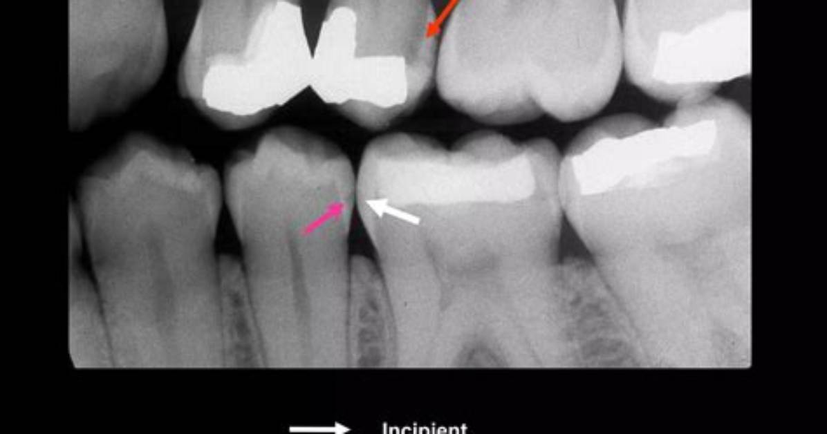 Should Incipient Caries Be Filled?
