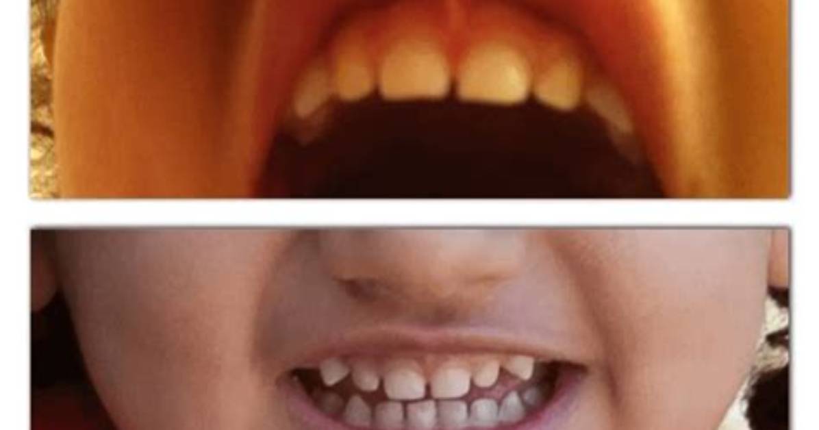 Should Lip Tie Be Corrected?