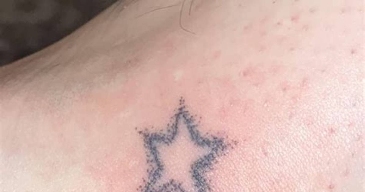 Should Stick N Pokes Bleed?
