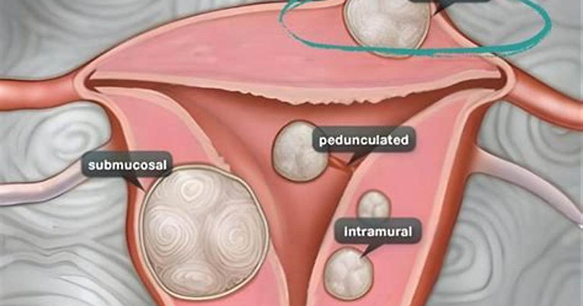 Should Subserosal Fibroids Be Removed?