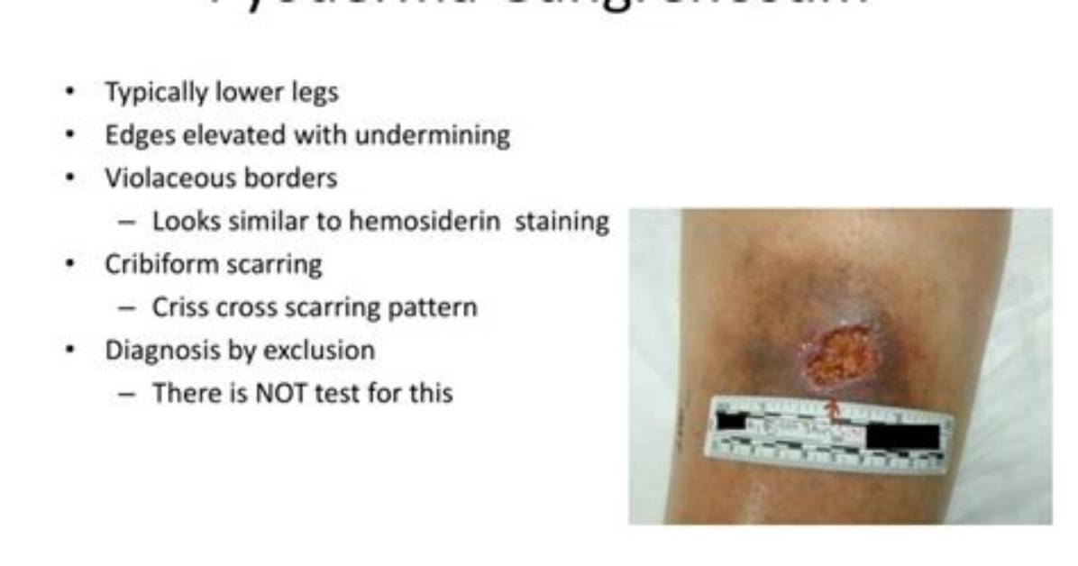 Should You Debride Pyoderma Gangrenosum?