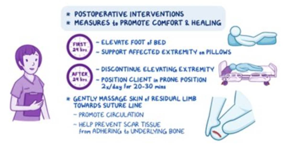 Should You Elevate an Amputation?