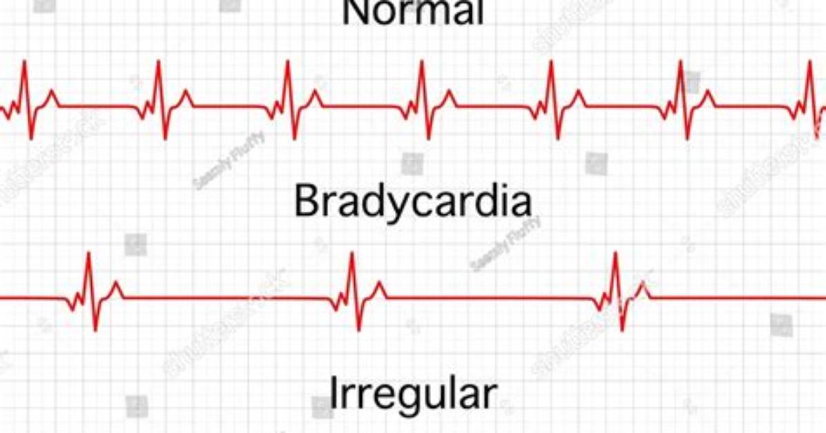 Should You Exercise with Bradycardia?
