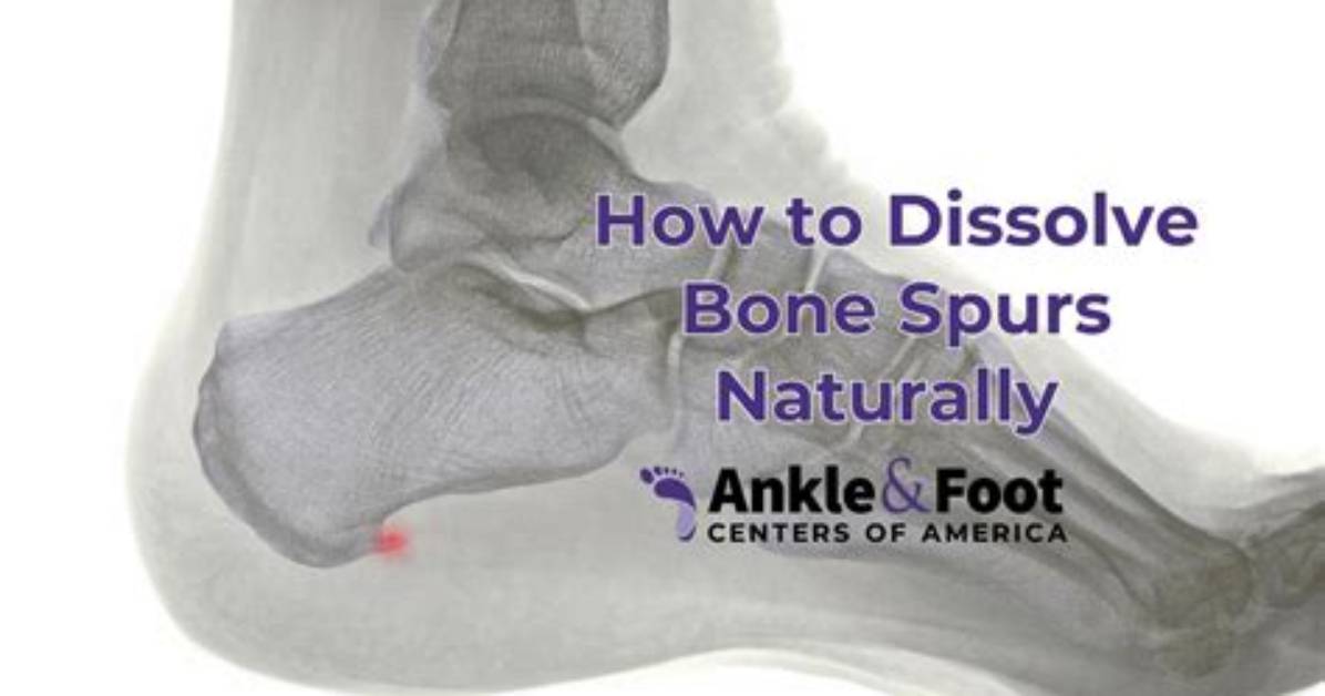Should You Ice a Bone Spur?