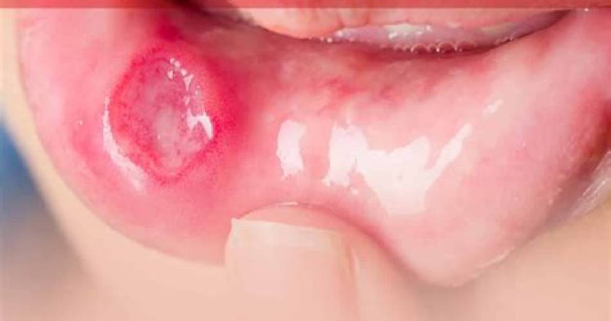 Should You Pop Canker Sores?