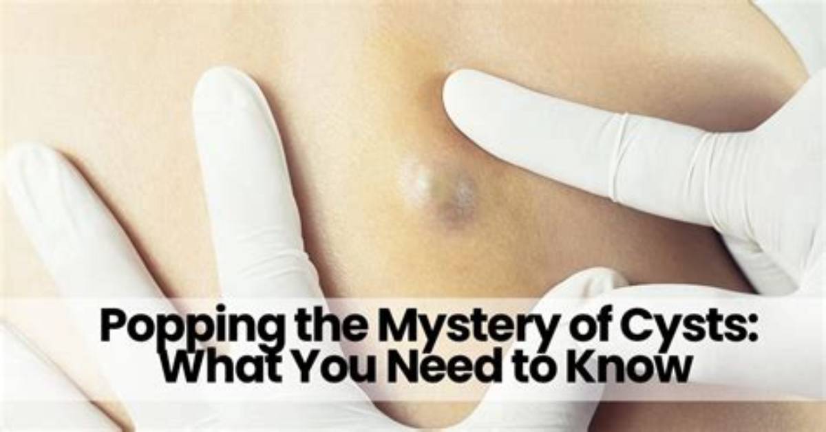 Should You Pop Cysts?