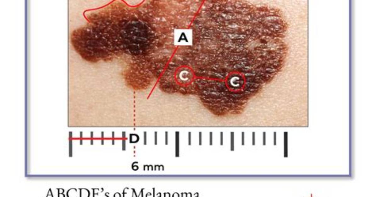 Should You Remove Malignant Melanoma?