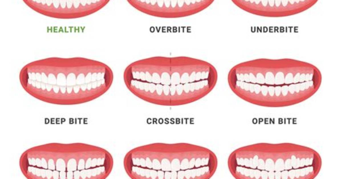 Should Your Teeth Be Clenched?