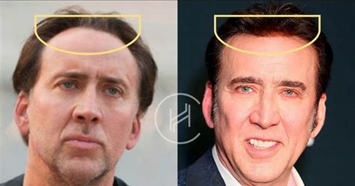 Truth About Nicolas Cage’s Hair Transplant and Hair Loss