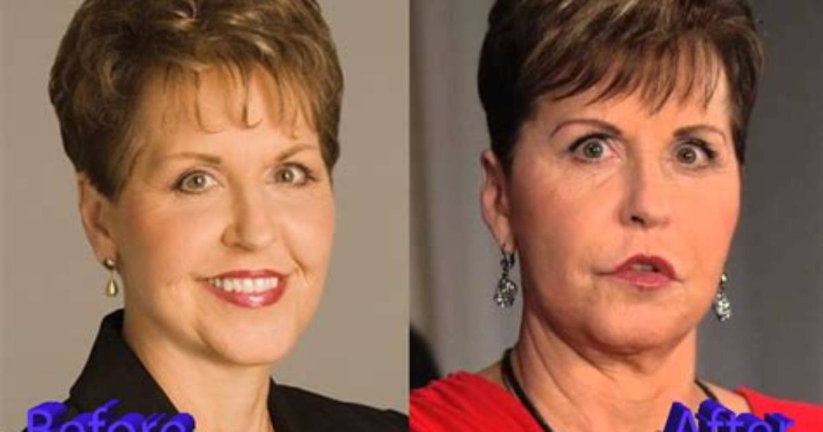 Truth Behind Joyce Meyer’s Plastic Surgery Rumor