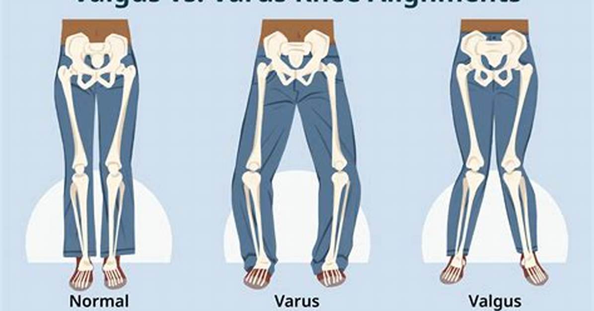 Valgus vs Varus