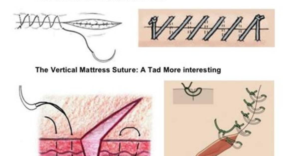 Vertical Mattress Suture