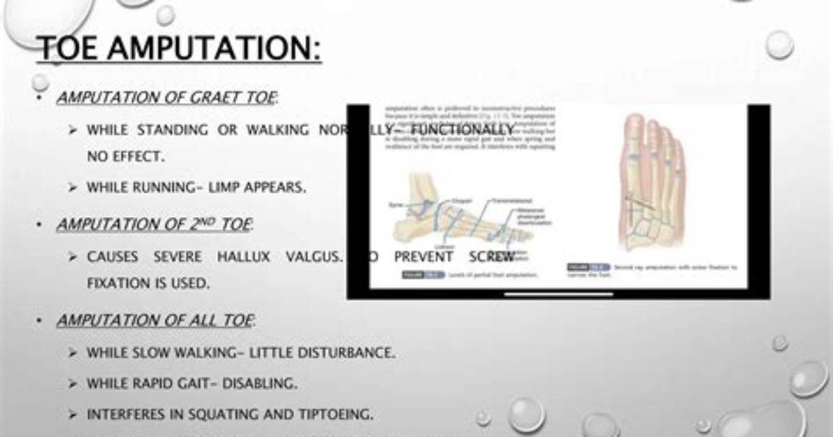 Walking After Toe Amputation