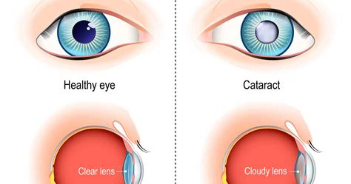 Was Diagnosed with Cataracts?