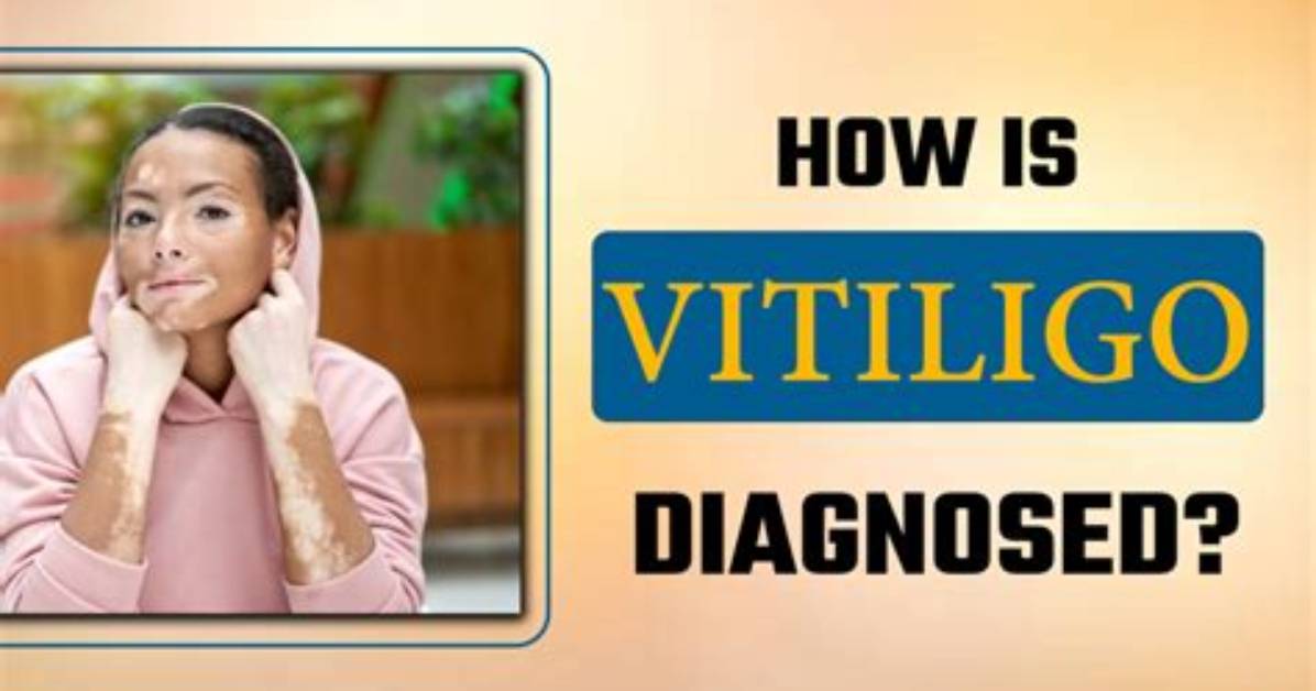 Was Diagnosed with Vitiligo?