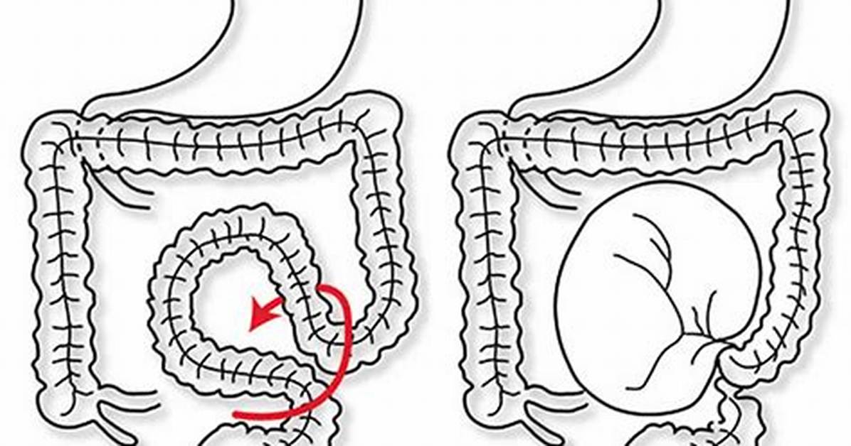 Was Ist Sigmoid Volvulus?