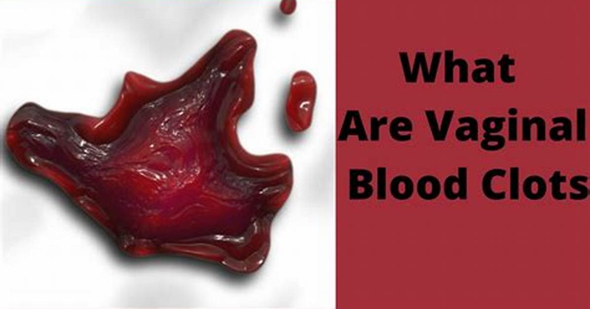 Were Do Blood Clots Start?