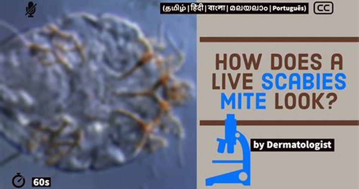 Were Do Scabies Live?