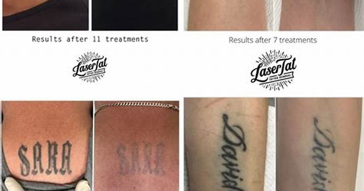 Were to Remove Tattoos?