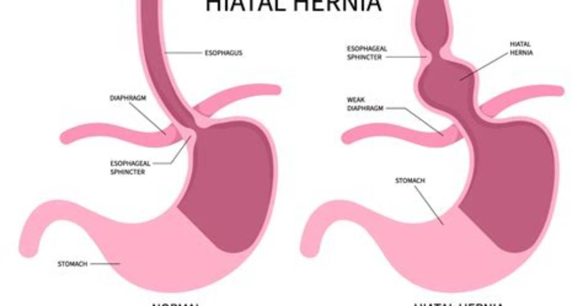 What Aggravates a Hiatal Hernia