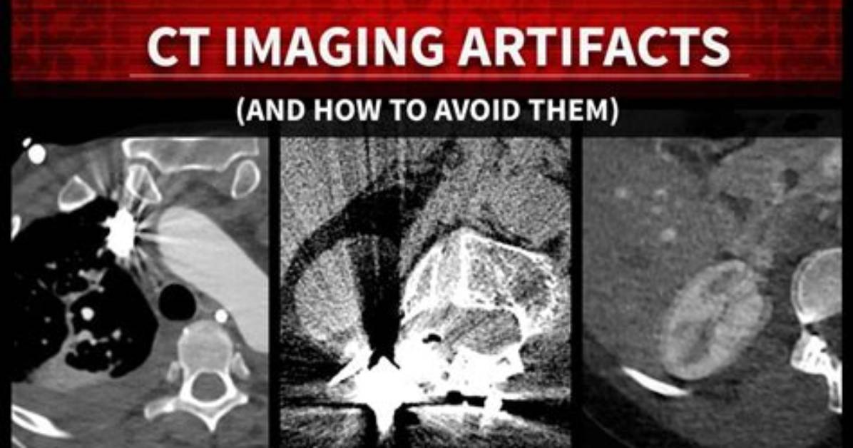 What Are Artifacts in Imaging?