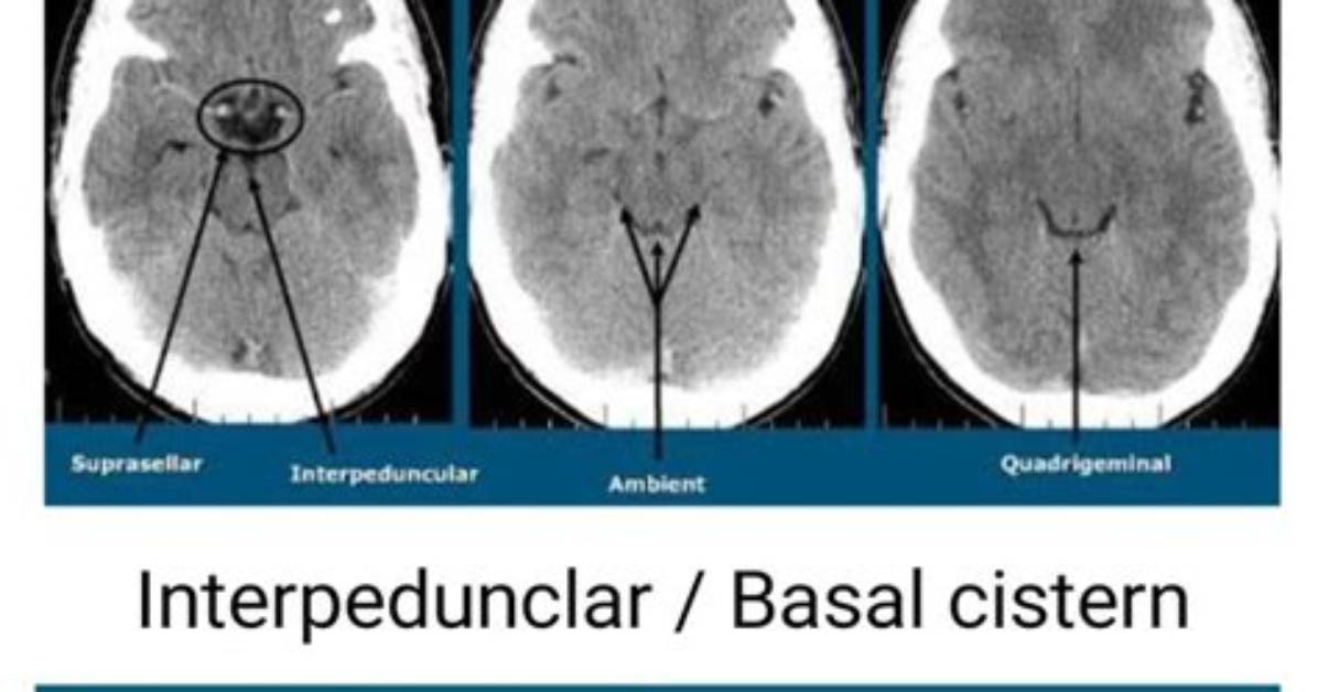 What Are Basal Cisterns?