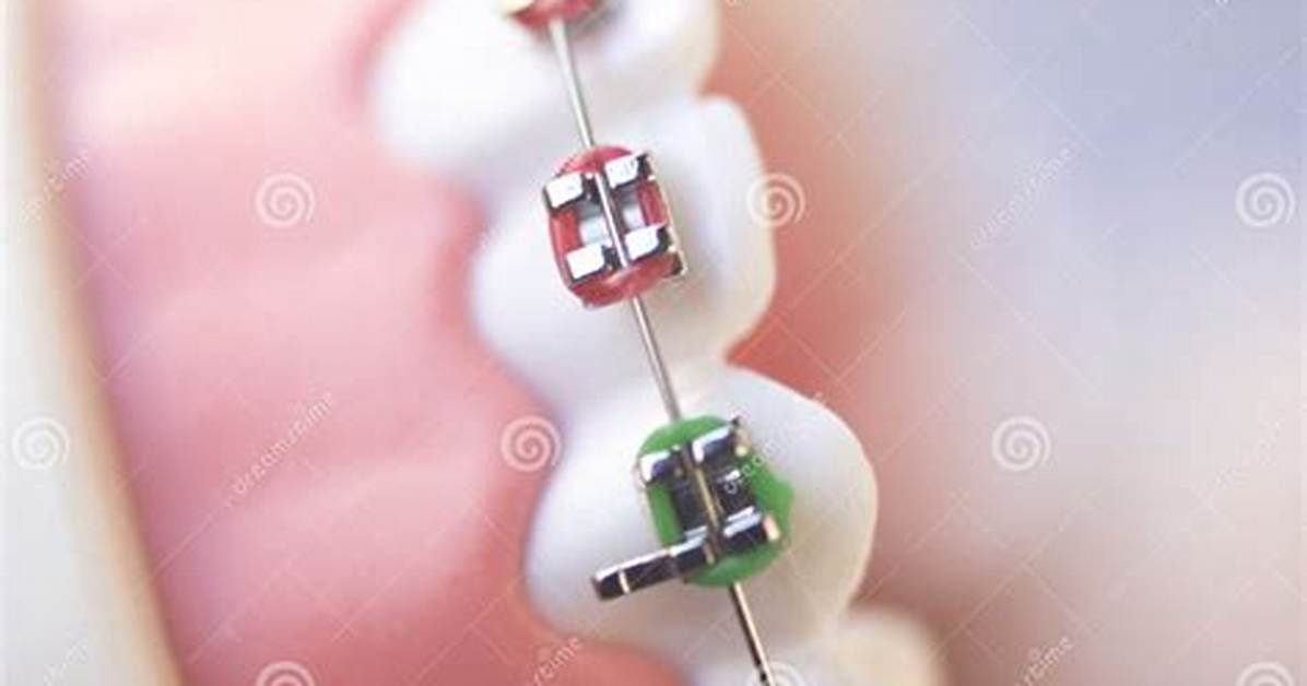 What Are Brackets in Dentistry