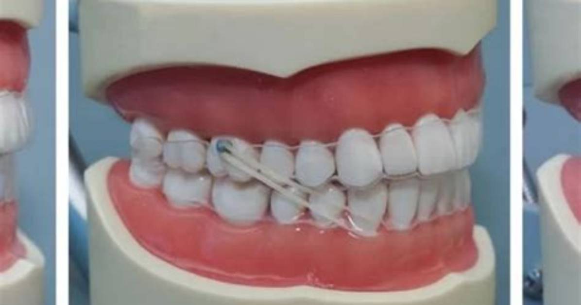 What Are Intermaxillary Elastics?