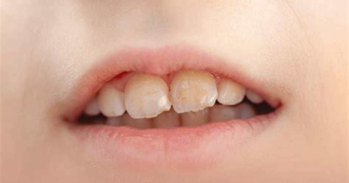 What Are Mottled Teeth