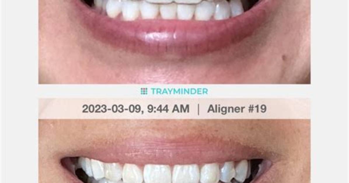 What Are Refinements Invisalign?